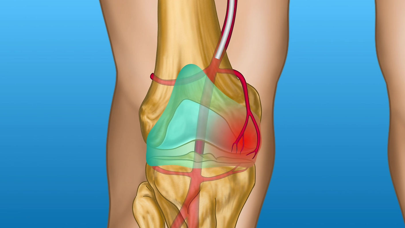 Knee  Pain: GAE